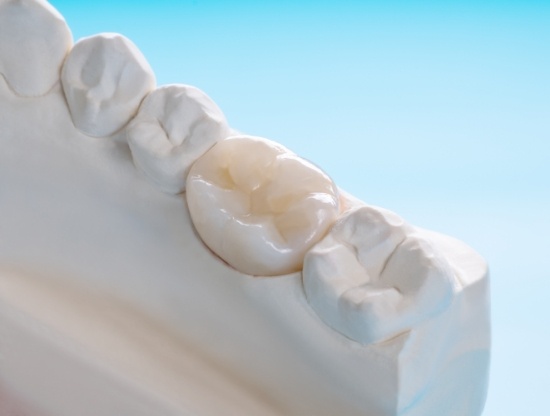 Model of mouth with a dental crown in Rocky Hill covering one tooth