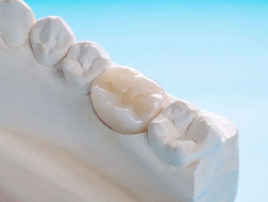 Diagram of how dental crowns in Rocky Hill are placed