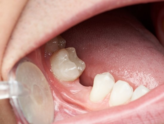 Close up of mouth with one missing lower tooth