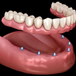 Implant dentures in Rocky Hill