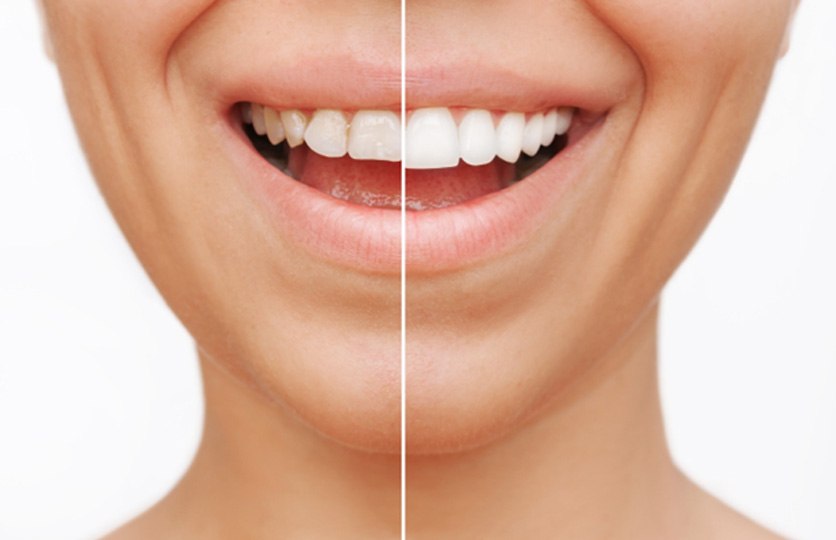 a smile before and after getting veneers  