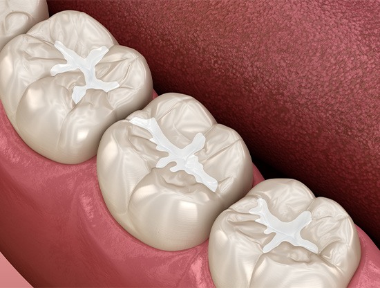 Illustration of teeth with tooth-colored fillings in Rocky Hill