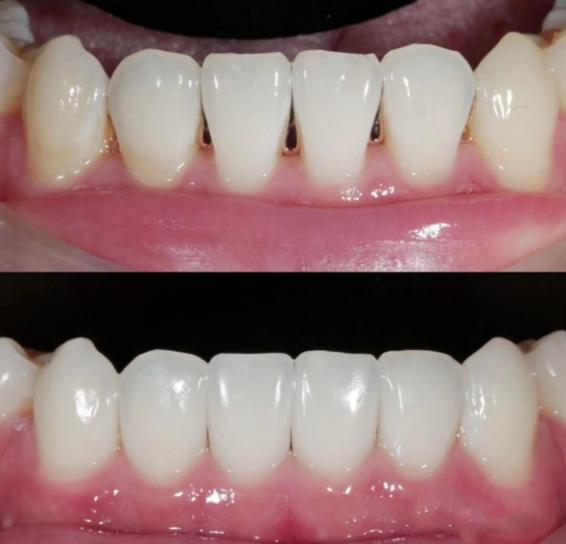 Close up of lower teeth before and after fixing small gaps between them with Bioclear