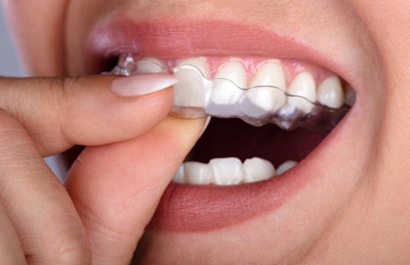 close-up of a person putting an Invisalign aligner over their teeth