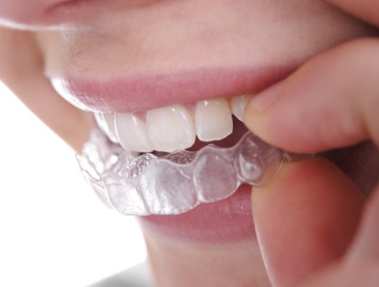 Close up of person placing a Sure Smile clear aligner over their teeth