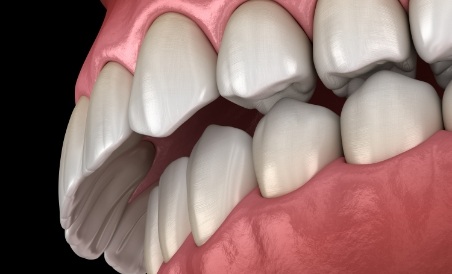 Illustrated mouth with overbite