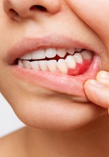 A close up of irritated gums