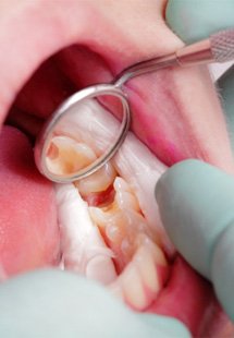 A close up of a mouth with a cavity