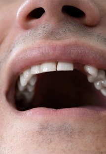 A man who is missing a tooth
