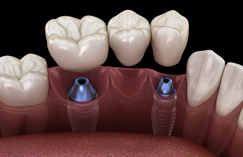 Animated dental implant supported dental bridge placement