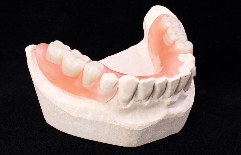 Model smile with partial denture restoration