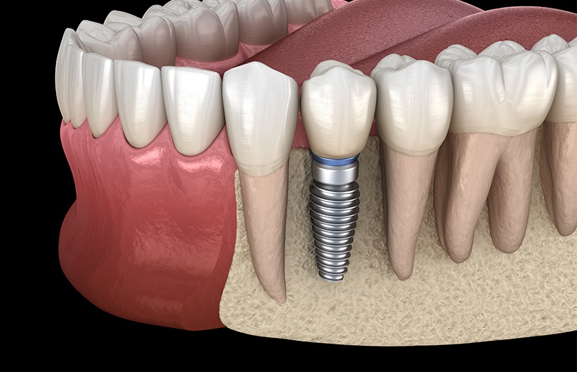Animated dental implant supported dental crown restoration