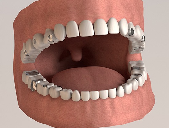 Illustration of mouth with multiple amalgam fillings