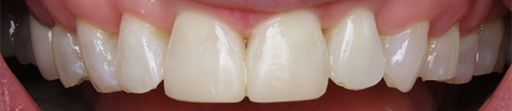 Smile gallery - after image #1 of composite bonding