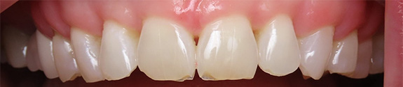 Smile gallery - before image #1 of composite bonding
