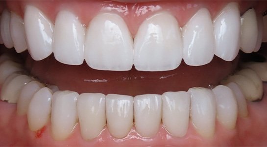 Smile gallery - after image #1 of cosmetic porcelain