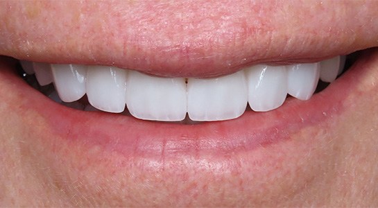 Smile gallery - after image #2 of cosmetic porcelain