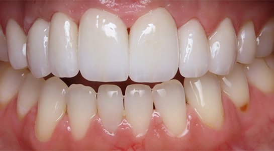 Smile gallery - after image #3 of cosmetic porcelain