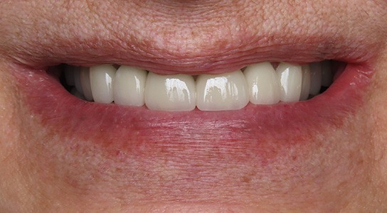 Smile gallery - after image #4 of cosmetic porcelain