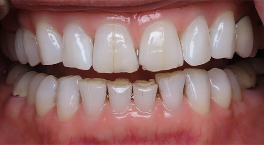Smile gallery - before image #1 of cosmetic porcelain