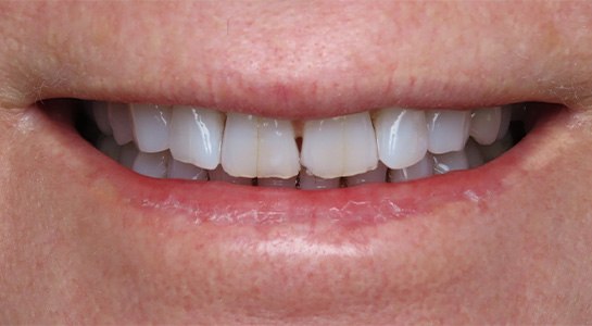 Smile gallery - before image #2 of cosmetic porcelain