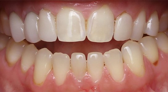 Smile gallery - before image #3 of cosmetic porcelain