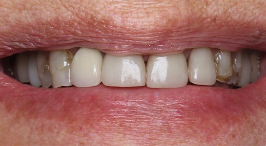 Smile gallery - before image #4 of cosmetic porcelain