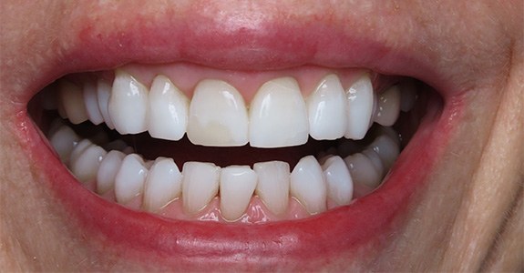 Smile gallery - after image #1 of kor