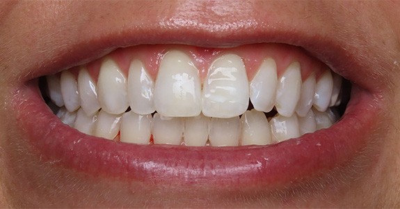 Smile gallery - after image #2 of kor