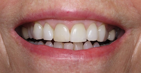 Smile gallery - before image #1 of kor