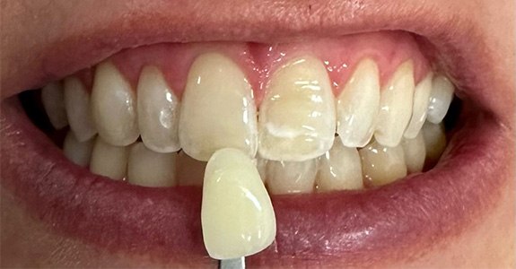 Smile gallery - before image #2 of kor