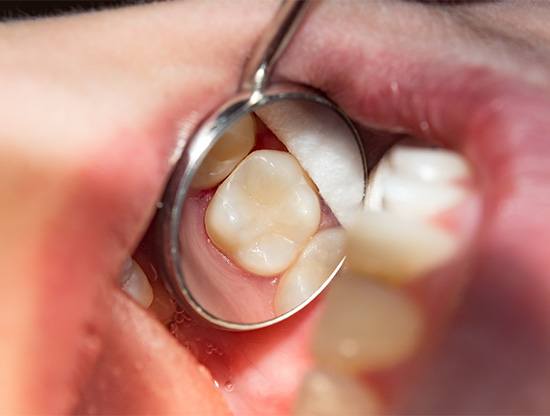 Using dental mirror to examine tooth after filling has been placed