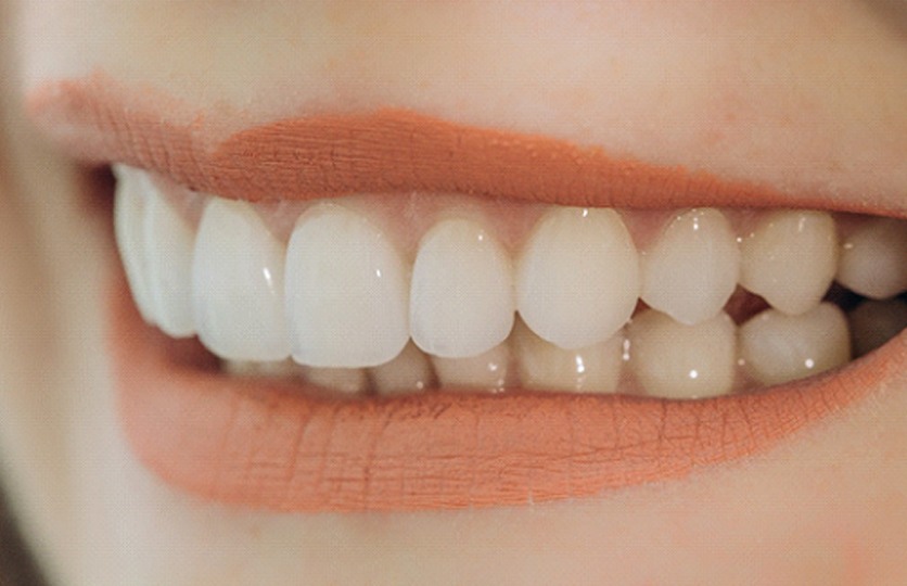 Closeup of woman smiling with veneers in Rocky Hill