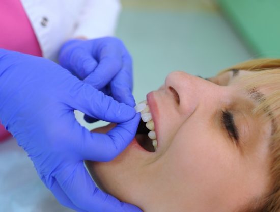Dentist placing a veneer over a patients tooth