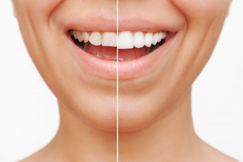 before and after veneer treatment