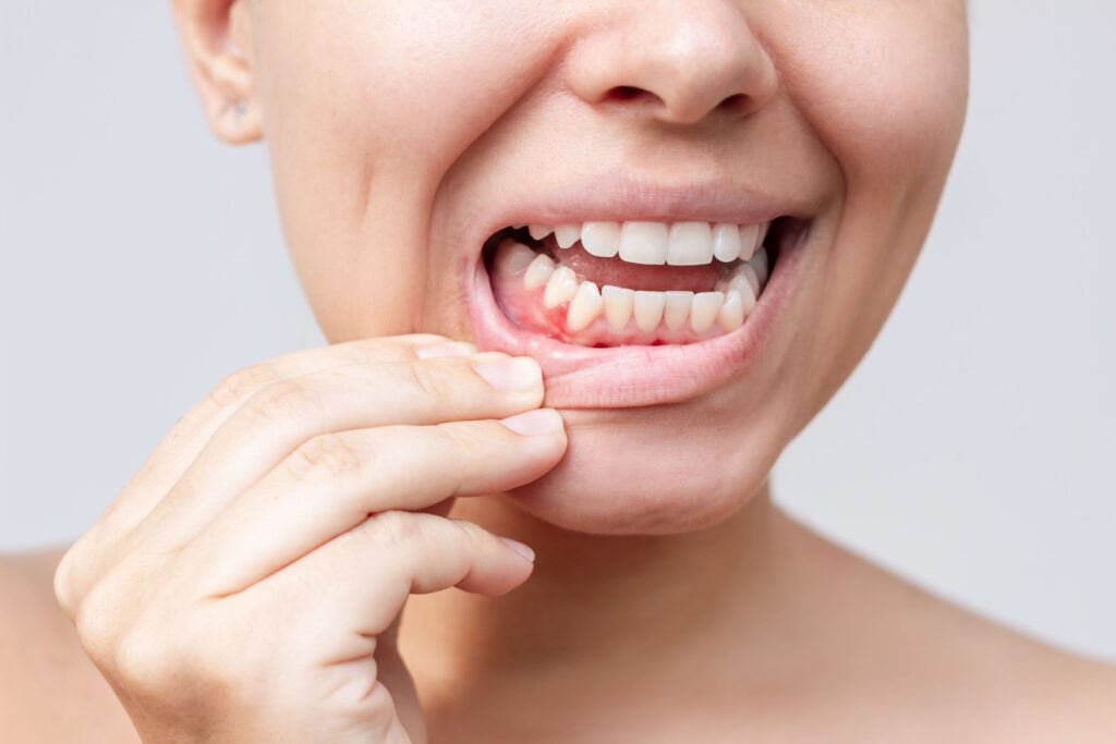 Woman pulling down lower lip to reveal red lump on gums between teeth